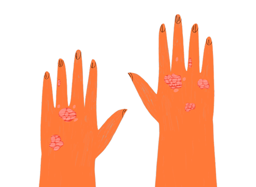 Illustration of hands with psoriasis plaques