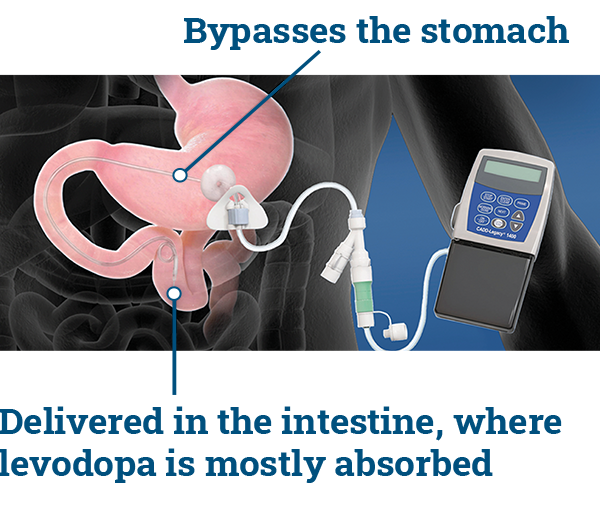 Duopa Bypasses Stomach, Delivered in Intestine