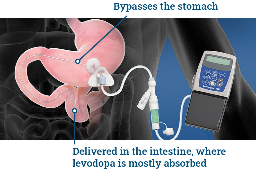 Duopa Bypasses Stomach, Delivered in Intestine