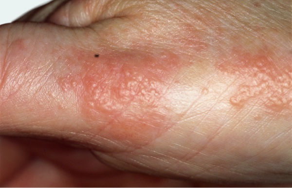 Eczema on knuckles