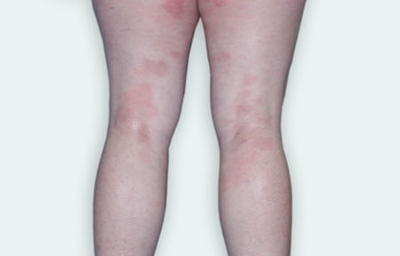 Eczema on back of legs