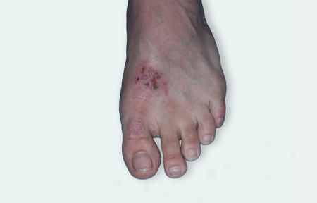 Eczema on feet