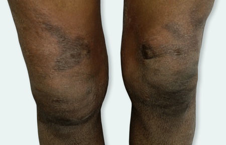 Eczema on knees