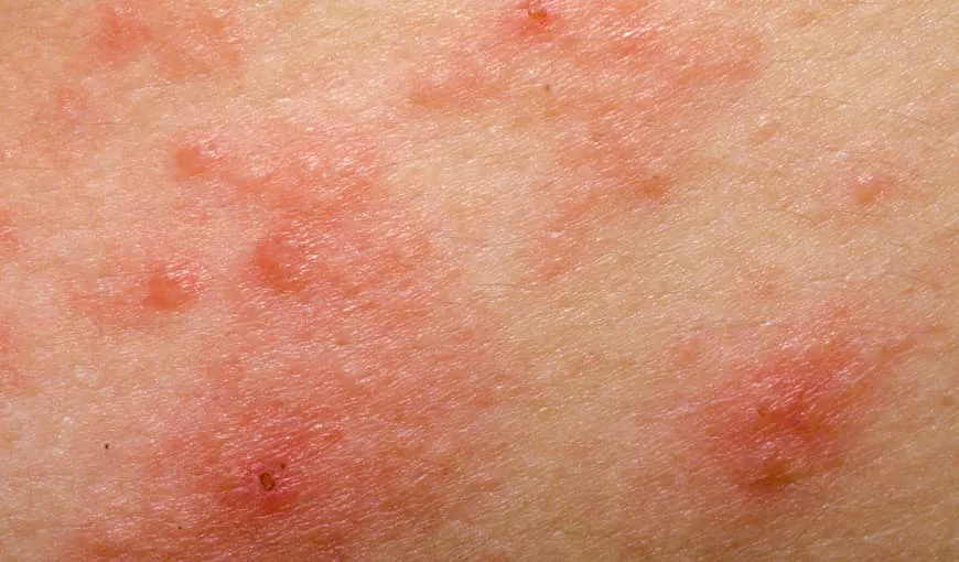 Close-up of eczema