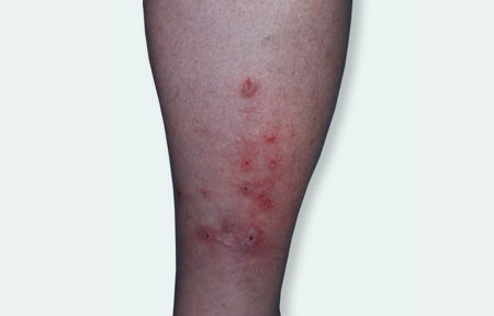 Eczema on thighs