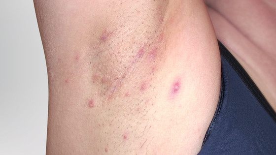 Hidradenitis suppurativa armpit: Stage 2 (moderate)