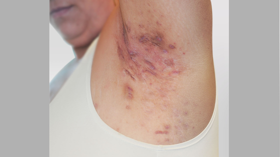 Hidradenitis suppurativa armpit: Stage 3 (severe)