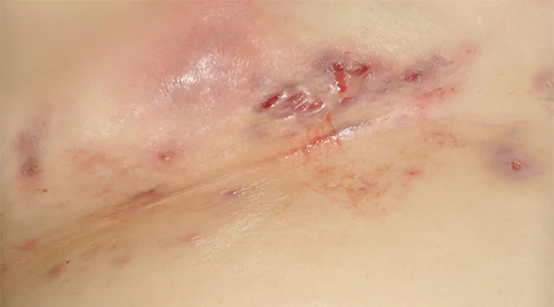Hidradenitis suppurativa under breast: Stage 3 (severe)