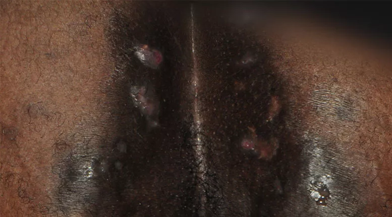 Hidradenitis suppurativa buttocks: Stage 3 (severe)