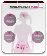 How Endometriosis Works Flashcard
