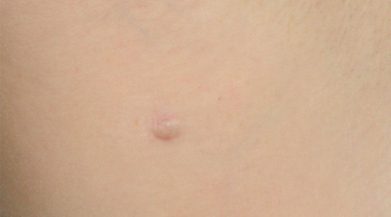 Hidradenitis suppurativa armpit: Stage 1 (mild)