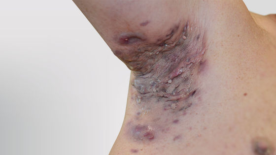 Hidradenitis suppurativa armpit: Stage 3 (severe)