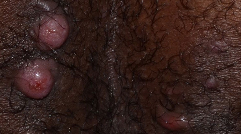 Hidradenitis suppurativa buttocks: Stage 2 (moderate)