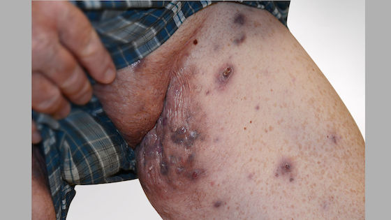 Hidradenitis suppurativa groin: Stage 3 (severe)