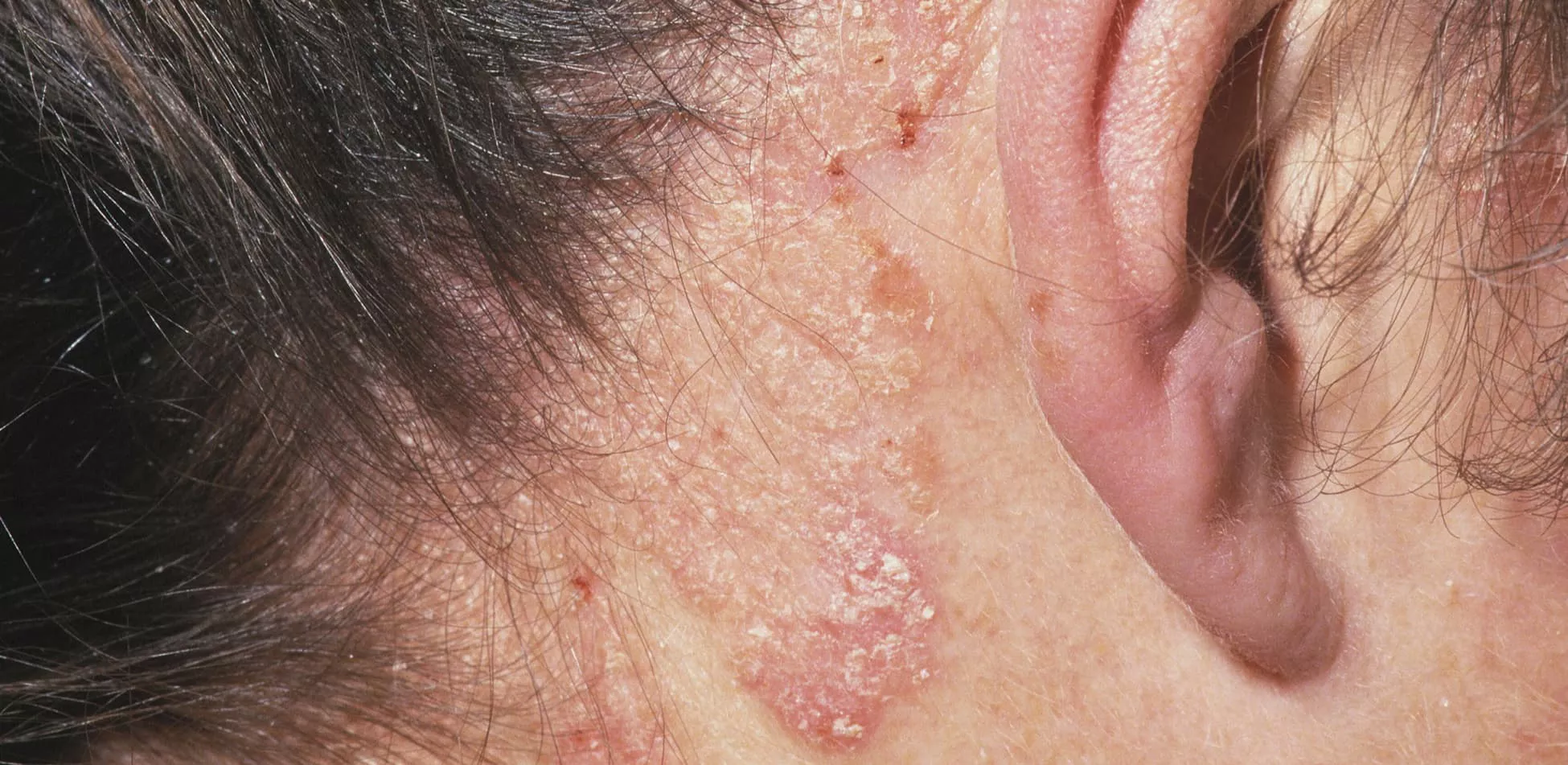 Picture of psoriasis on scalp behind ear