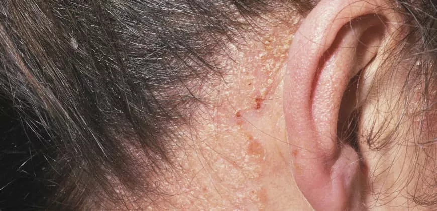 Picture of psoriasis on scalp behind ear