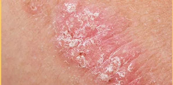 Picture of a psoriasis plaque