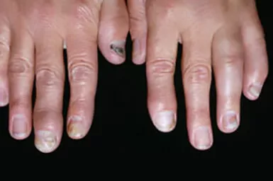 Fingernails with distal interphalangeal predominant