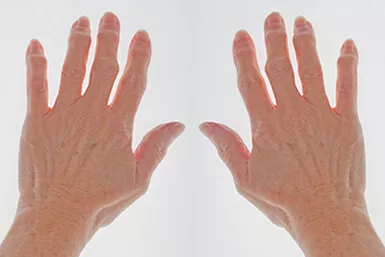 Hands with symmetric arthritis
