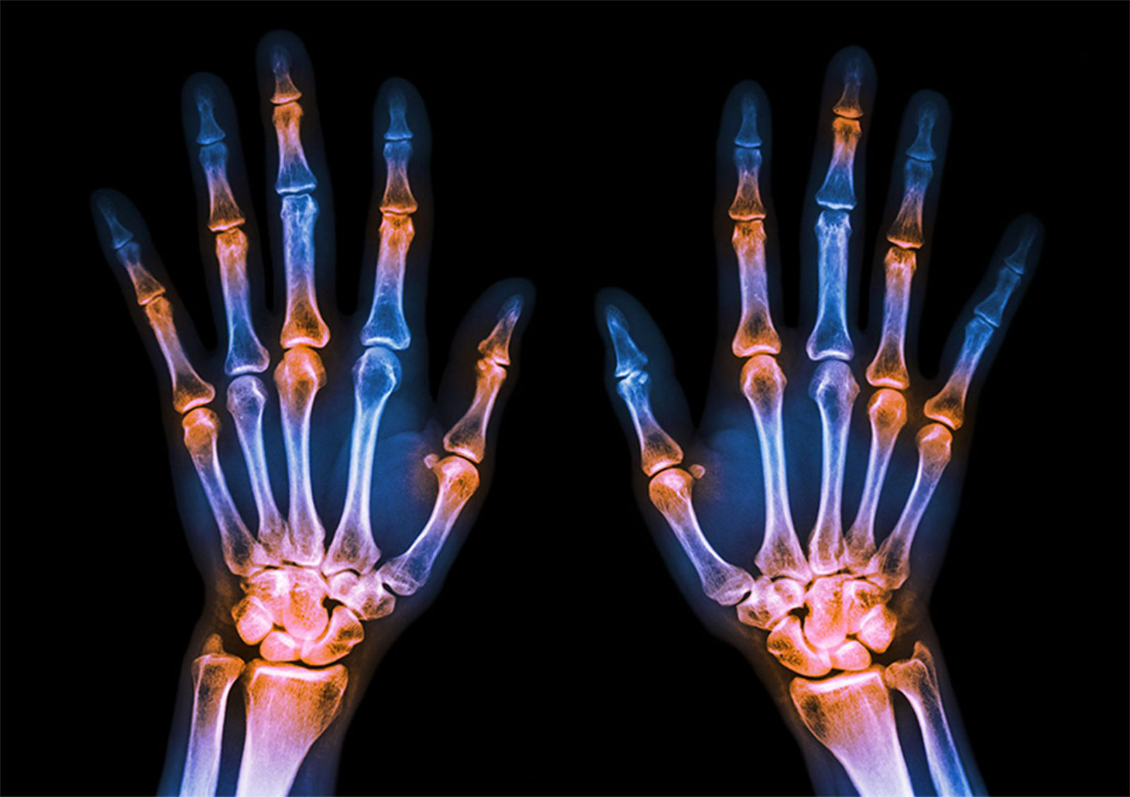 rheumatoid-arthritis